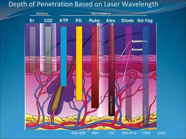 About Low Level Laser Therapy: Fat removal, lipoplasty / liposuction techniques.