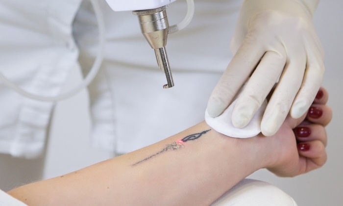 Tattoo removal with a 10 watt DPSS 1064 nm Nd:YAG laser module